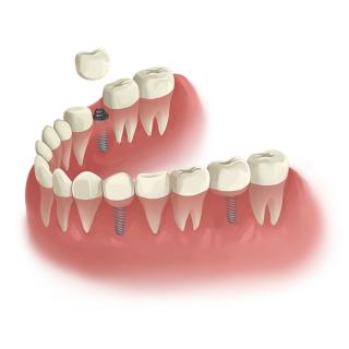 When do I need Wisdom Tooth Removal? logo