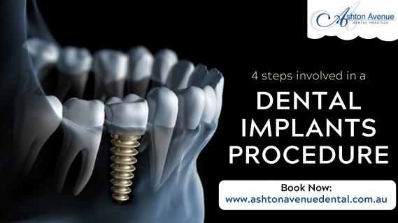 Dental Implant Procedure: A Step by Step Guide Video logo